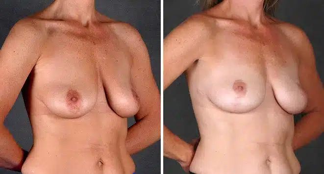 Breast Lift Before and After Photos in Omaha, NE, Case 5727