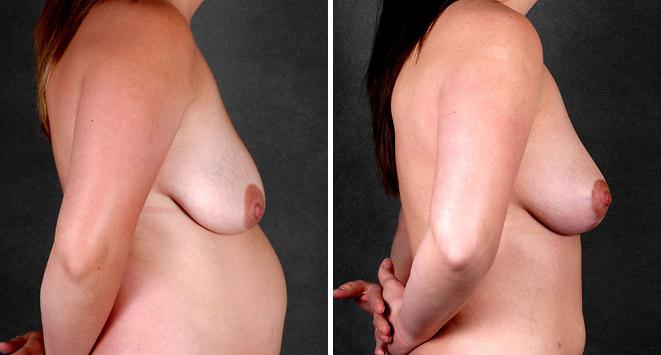 Breast Lift Before and After Photos in Omaha, NE, Case 5697