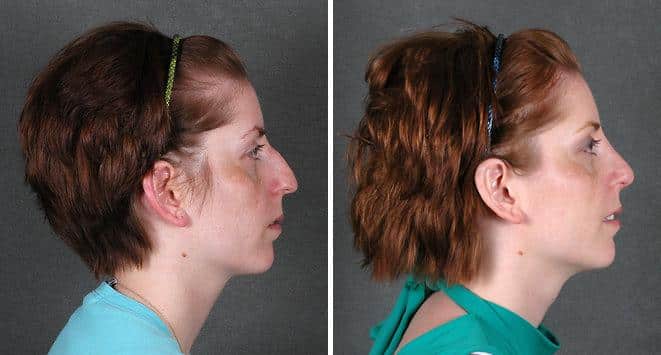 Rhinoplasty Before and After Photos in Omaha, NE, Case 5784