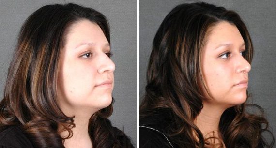 Rhinoplasty Before and After Photos in Omaha, NE, Case 5812