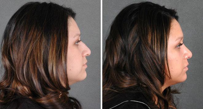 Rhinoplasty Before and After Photos in Omaha, NE, Case 5812