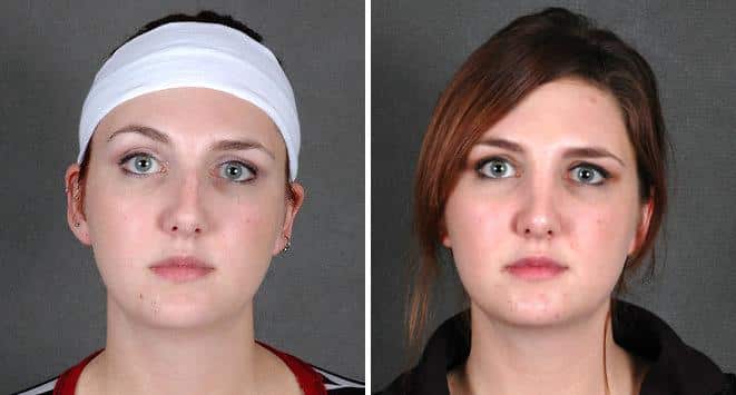 Rhinoplasty Before and After Photos in Omaha, NE, Case 5825