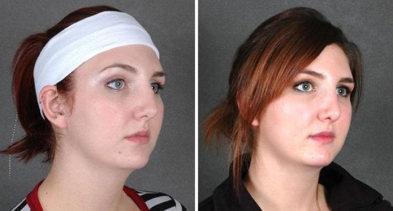 Rhinoplasty Before and After Photos in Omaha, NE, Case 5825