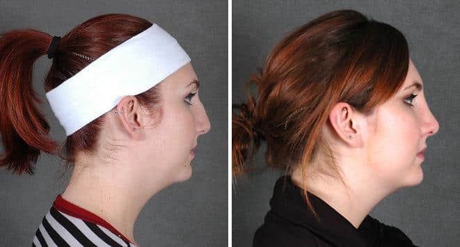 Rhinoplasty Before and After Photos in Omaha, NE, Case 5825