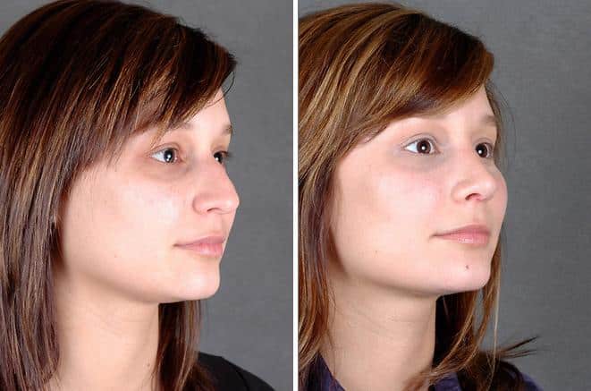 Rhinoplasty Before and After Photos in Omaha, NE, Case 5839