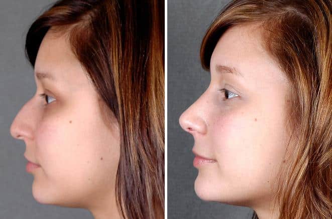 Rhinoplasty Before and After Photos in Omaha, NE, Case 5839