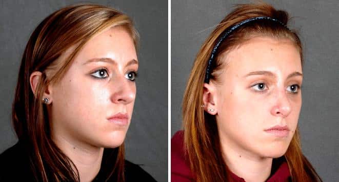 Rhinoplasty Before and After Photos in Omaha, NE, Case 5845