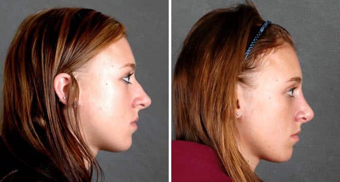 Rhinoplasty Before and After Photos in Omaha, NE, Case 5845