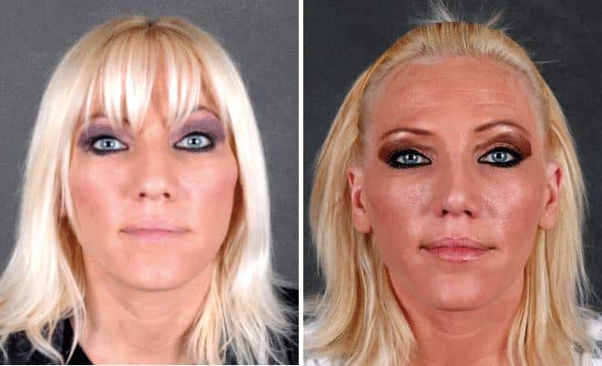 Rhinoplasty Before and After Photos in Omaha, NE, Case 5857