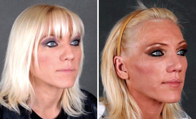 Rhinoplasty Before and After Photos in Omaha, NE, Case 5857
