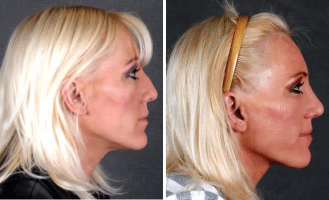 Rhinoplasty Before and After Photos in Omaha, NE, Case 5857