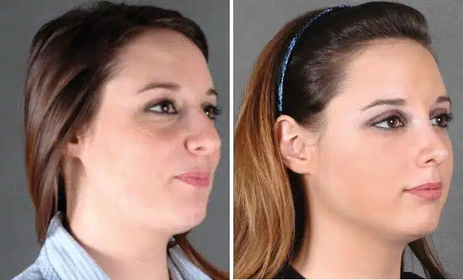 Rhinoplasty Before and After Photos in Omaha, NE, Case 5776