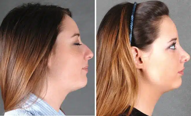 Rhinoplasty Before and After Photos in Omaha, NE, Case 5776