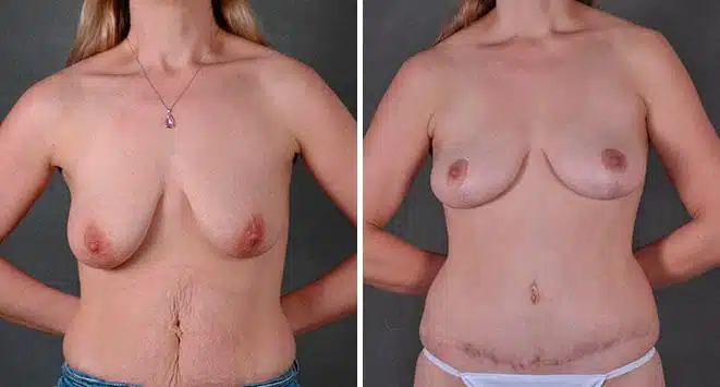 Breast Lift Before and After Photos in Omaha, NE, Case 7804