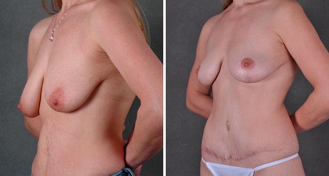 Breast Lift Before and After Photos in Omaha, NE, Case 7804