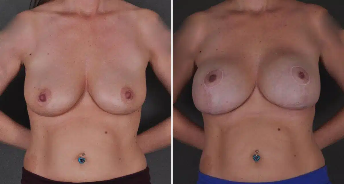 Breast Lift Before and After Photos in Omaha, NE, Case 8623