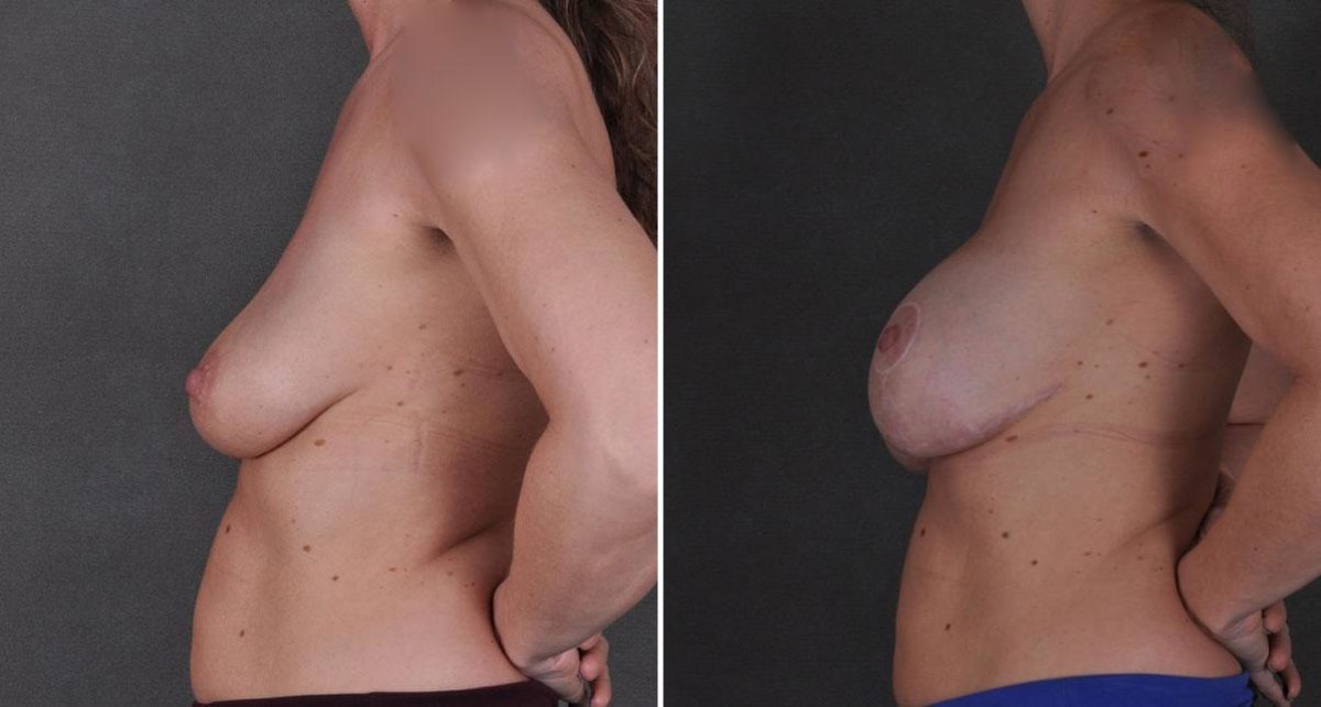 Breast Lift Before and After Photos in Omaha, NE, Case 8623