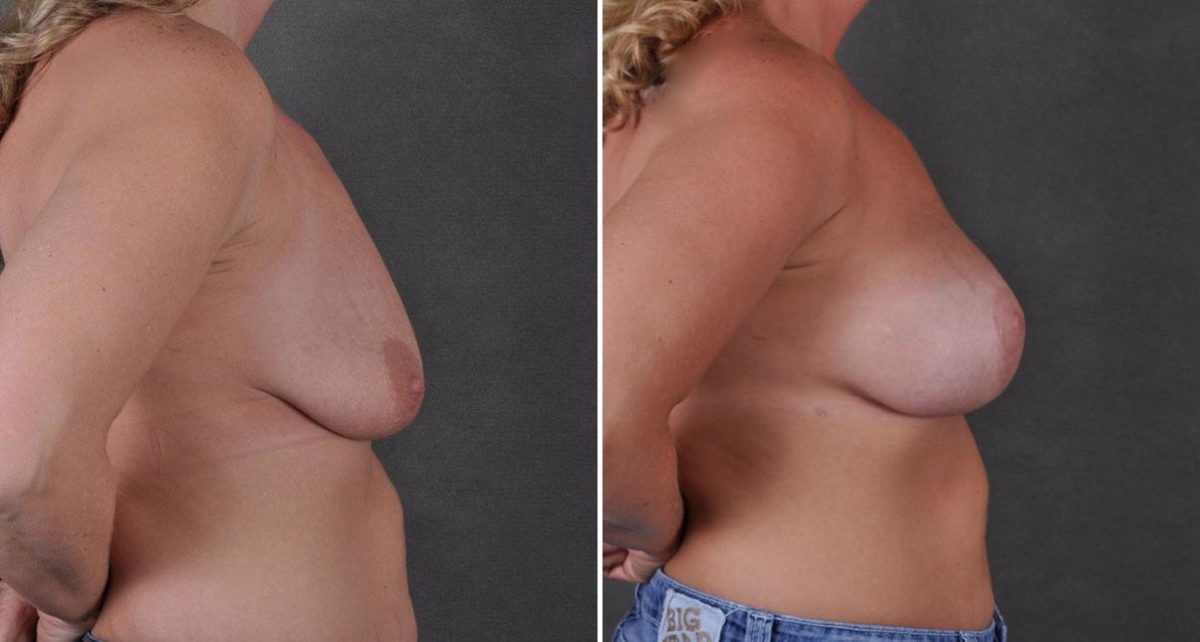 Breast Lift Before and After Photos in Omaha, NE, Case 8785