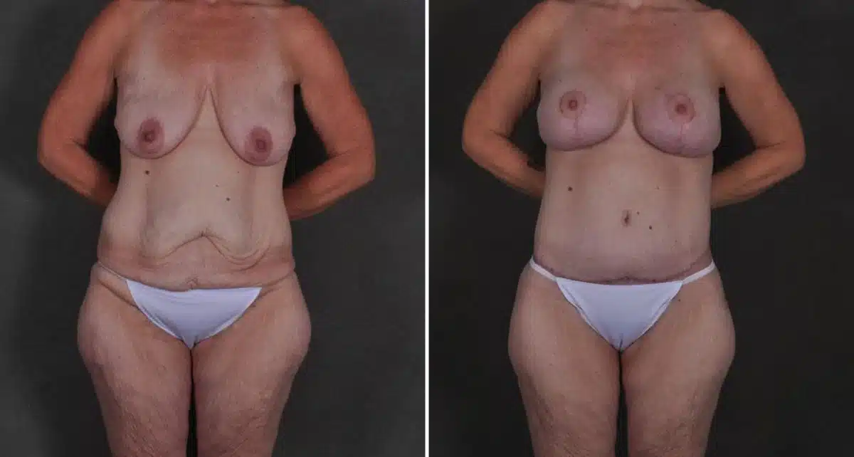 Breast Lift Before and After Photos in Omaha, NE, Case 8912