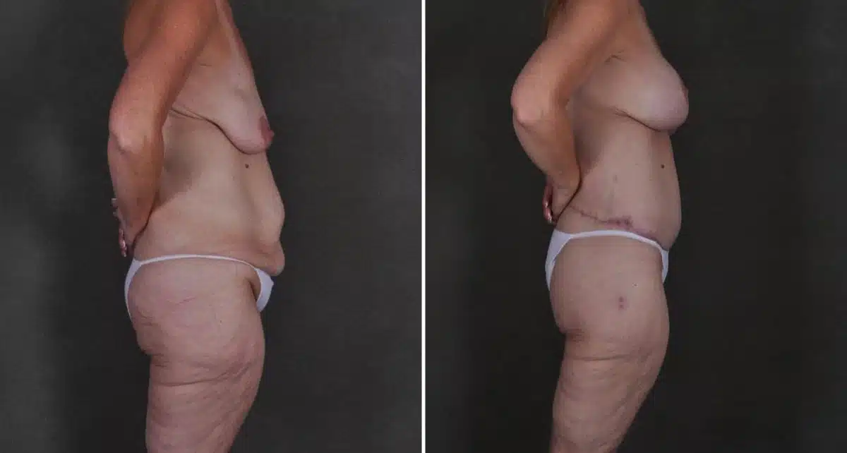 Breast Lift Before and After Photos in Omaha, NE, Case 8912