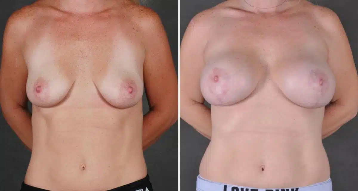 Breast Lift Before and After Photos in Omaha, NE, Case 9106