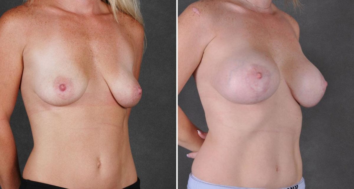 Case 9106, Breast Lift Before and After Photos Breast Lift Before and After Photos in Omaha, NE, Case 9106