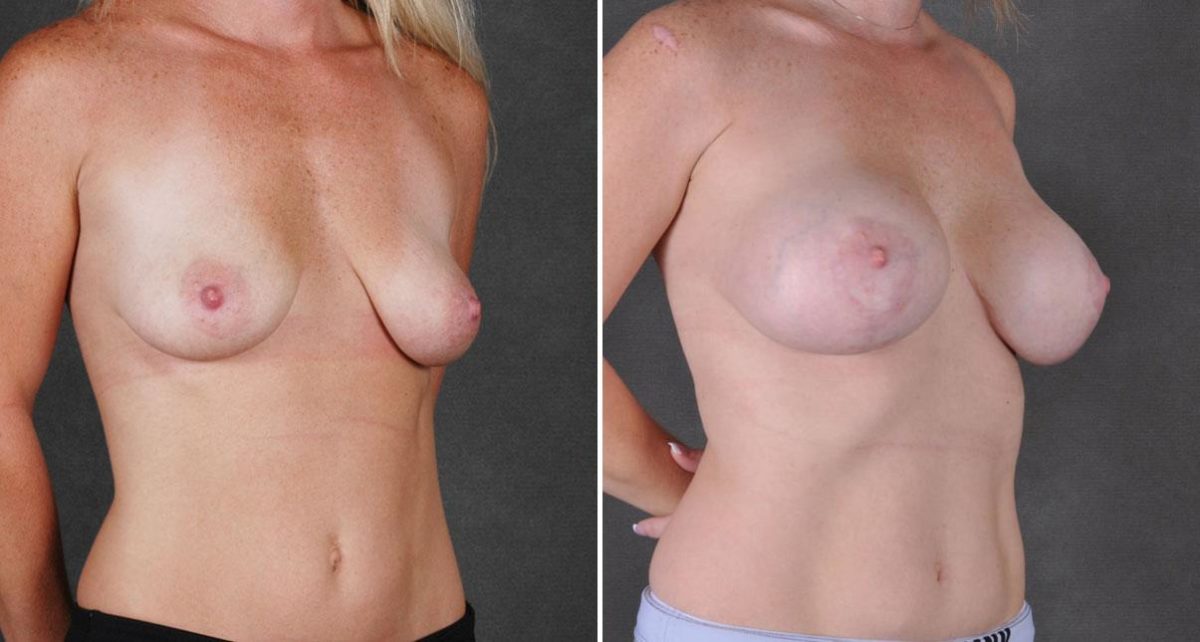 Breast Lift Before and After Photos in Omaha, NE, Case 9106