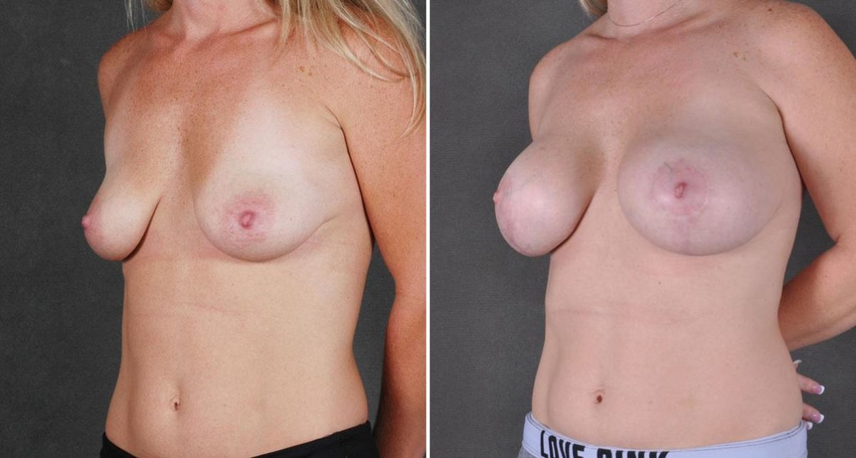 Breast Lift Before and After Photos in Omaha, NE, Case 9106