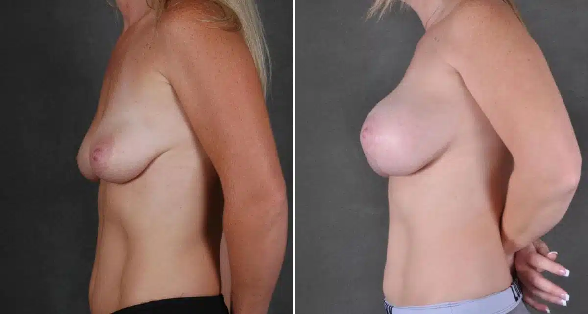 Breast Lift Before and After Photos in Omaha, NE, Case 9106