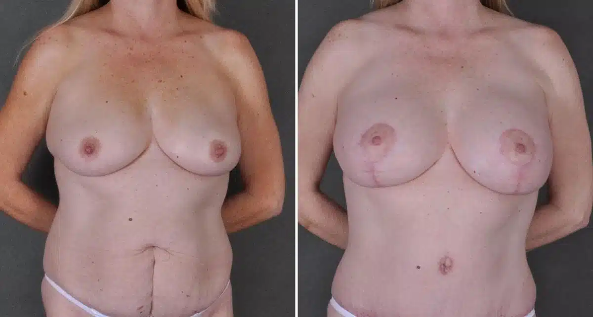 Breast Lift Before and After Photos in Omaha, NE, Case 9190