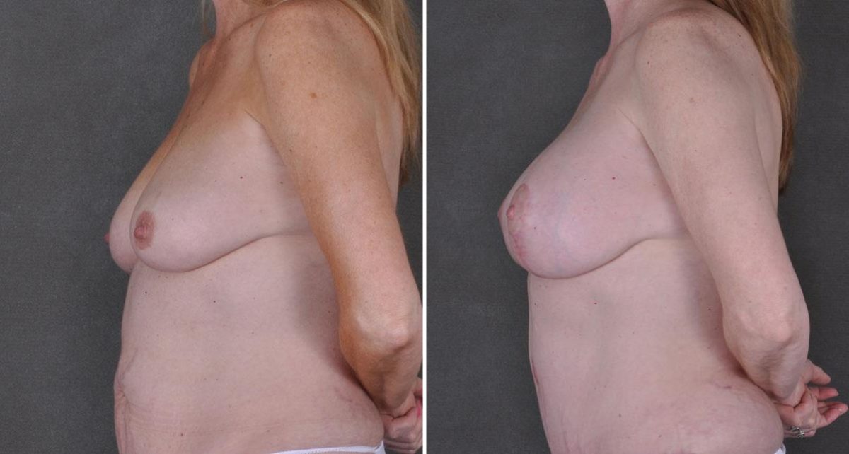 Breast Lift Before and After Photos in Omaha, NE, Case 9190