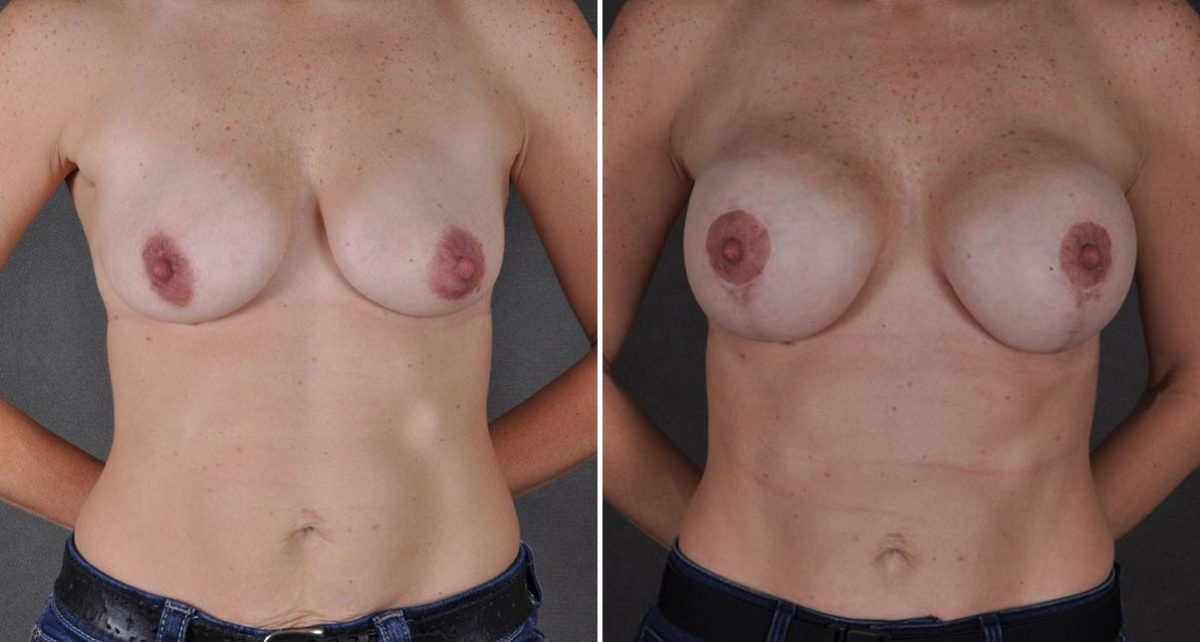Case 9205, Breast Lift Before and After Photos Breast Lift Before and After Photos in Omaha, NE, Case 9205