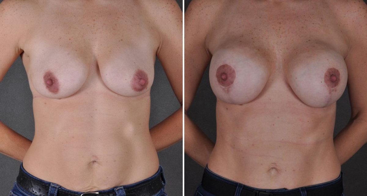 Breast Lift Before and After Photos in Omaha, NE, Case 9205