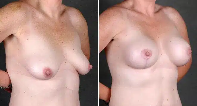 Case 5870, Breast Lift Before and After Photos Breast Lift Before and After Photos in Omaha, NE, Case 5870