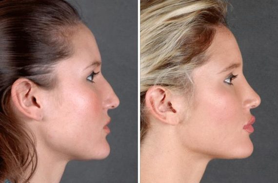 Rhinoplasty Before and After Photos in Omaha, NE, Case 5871