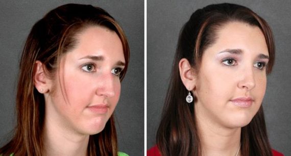 Rhinoplasty Before and After Photos in Omaha, NE, Case 5944