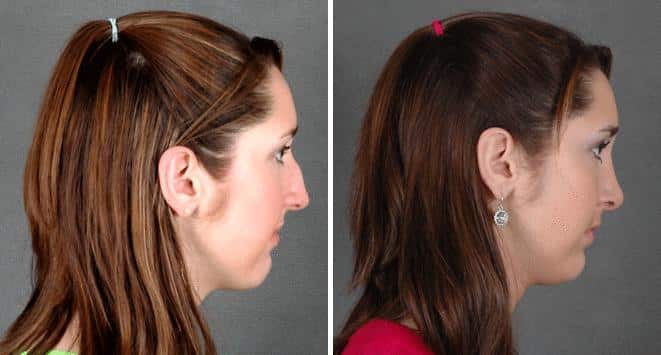 Rhinoplasty Before and After Photos in Omaha, NE, Case 5944