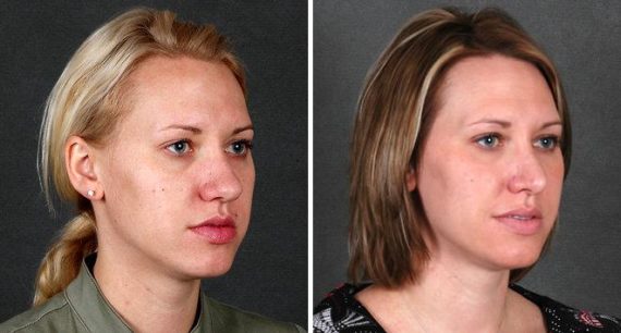 Rhinoplasty Before and After Photos in Omaha, NE, Case 5951