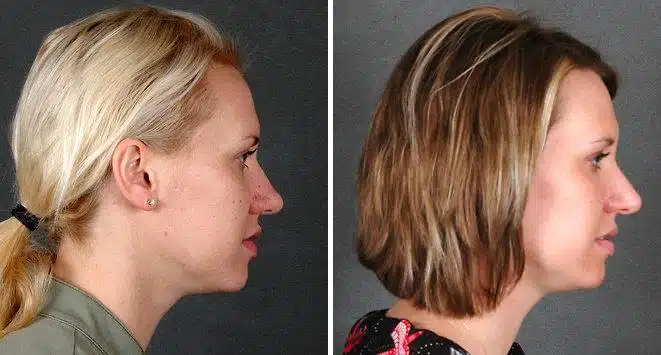 Rhinoplasty Before and After Photos in Omaha, NE, Case 5951