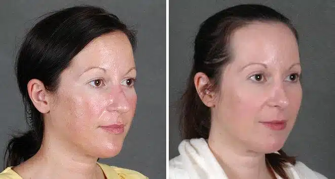 Rhinoplasty Before and After Photos in Omaha, NE, Case 5958