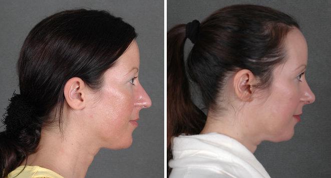 Rhinoplasty Before and After Photos in Omaha, NE, Case 5958