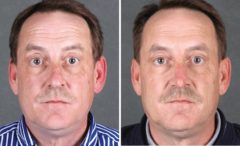 Rhinoplasty Before and After Photos in Omaha, NE, Case 5890