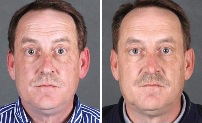 Rhinoplasty Before and After Photos in Omaha, NE, Case 5890