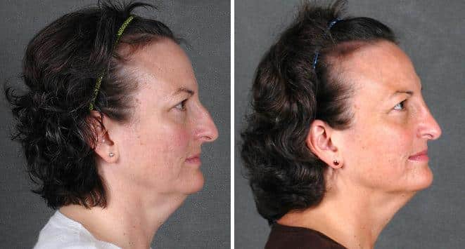 Rhinoplasty Before and After Photos in Omaha, NE, Case 5959