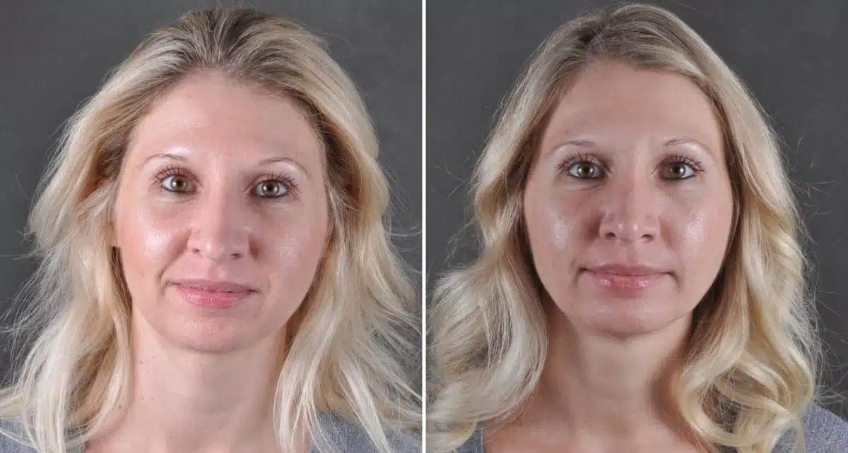 Rhinoplasty Before and After Photos in Omaha, NE, Case 8609