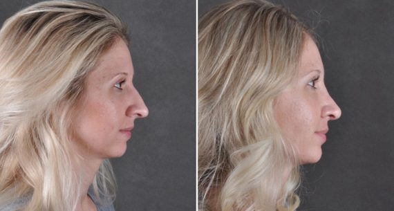 Rhinoplasty Before and After Photos in Omaha, NE, Case 8609