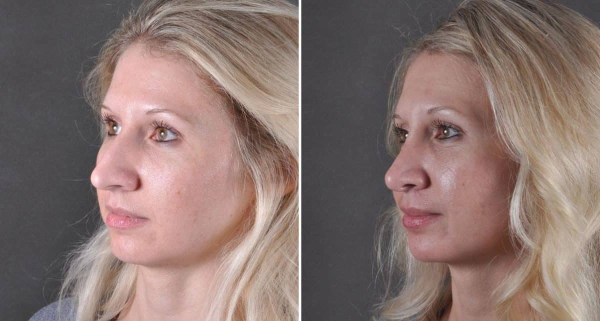 Rhinoplasty Before and After Photos in Omaha, NE, Case 8609