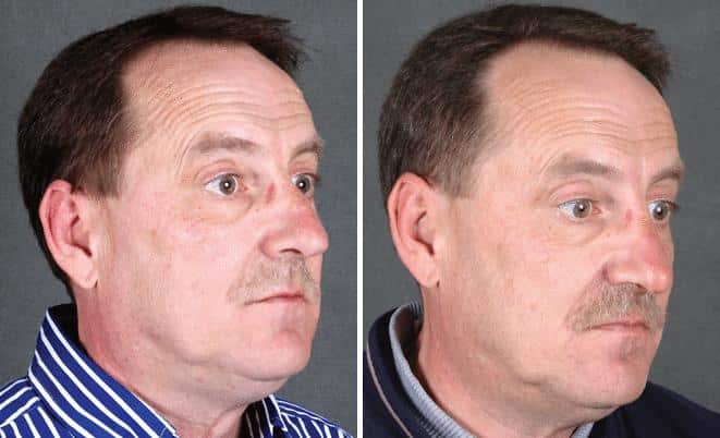 Rhinoplasty Before and After Photos in Omaha, NE, Case 5890
