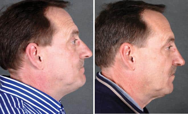 Rhinoplasty Before and After Photos in Omaha, NE, Case 5890