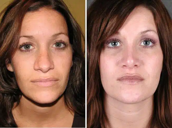 Rhinoplasty Before and After Photos in Omaha, NE, Case 5912